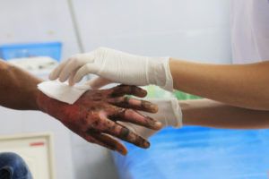 Dealing with the Aftermath of Severe Burn Injuries