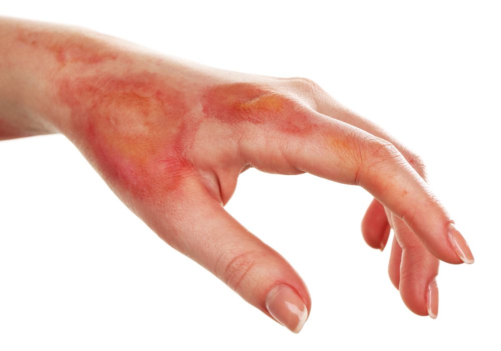 Long Island Burn Injury Lawyer